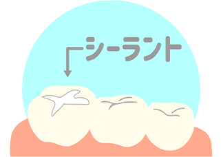 シーラント