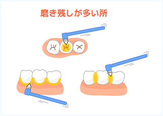 磨き残しが多いところ