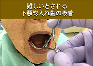 安定性の高い入れ歯をご提供いたします
