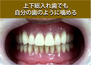 歯をすべて失った場合にもしっかり噛める