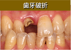 歯牙破折