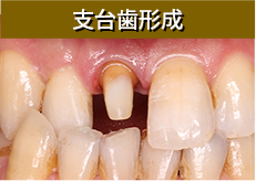支台歯形成 