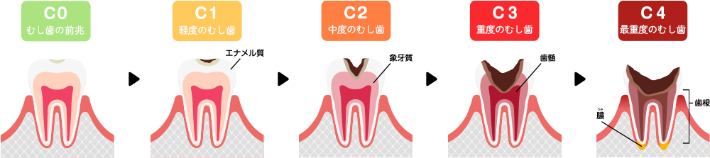 むし歯の進行