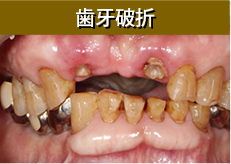 歯牙破折