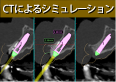CTによるシミュレーション