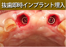 抜歯即時インプラント埋入