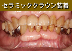 セラミッククラウン装着 