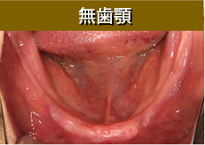 無歯顎