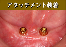 アタッチメント装着