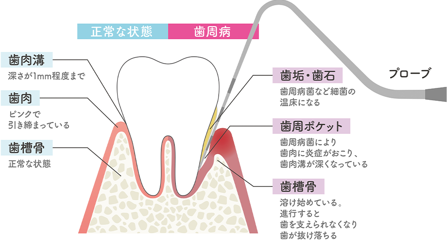 むし歯の進行