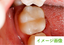 口腔内カメラモード